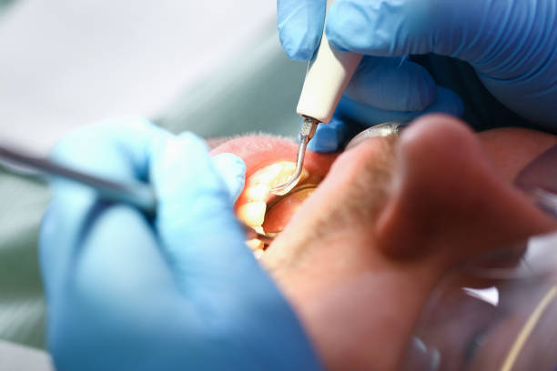 Best Emergency Wisdom Teeth Removal in Puxico, MO